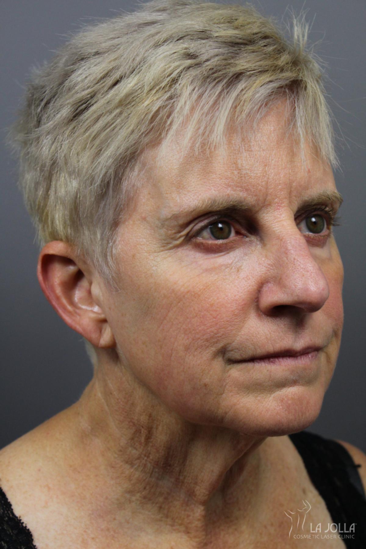 Poke A Dot Lift Patient 2 Before Procedure