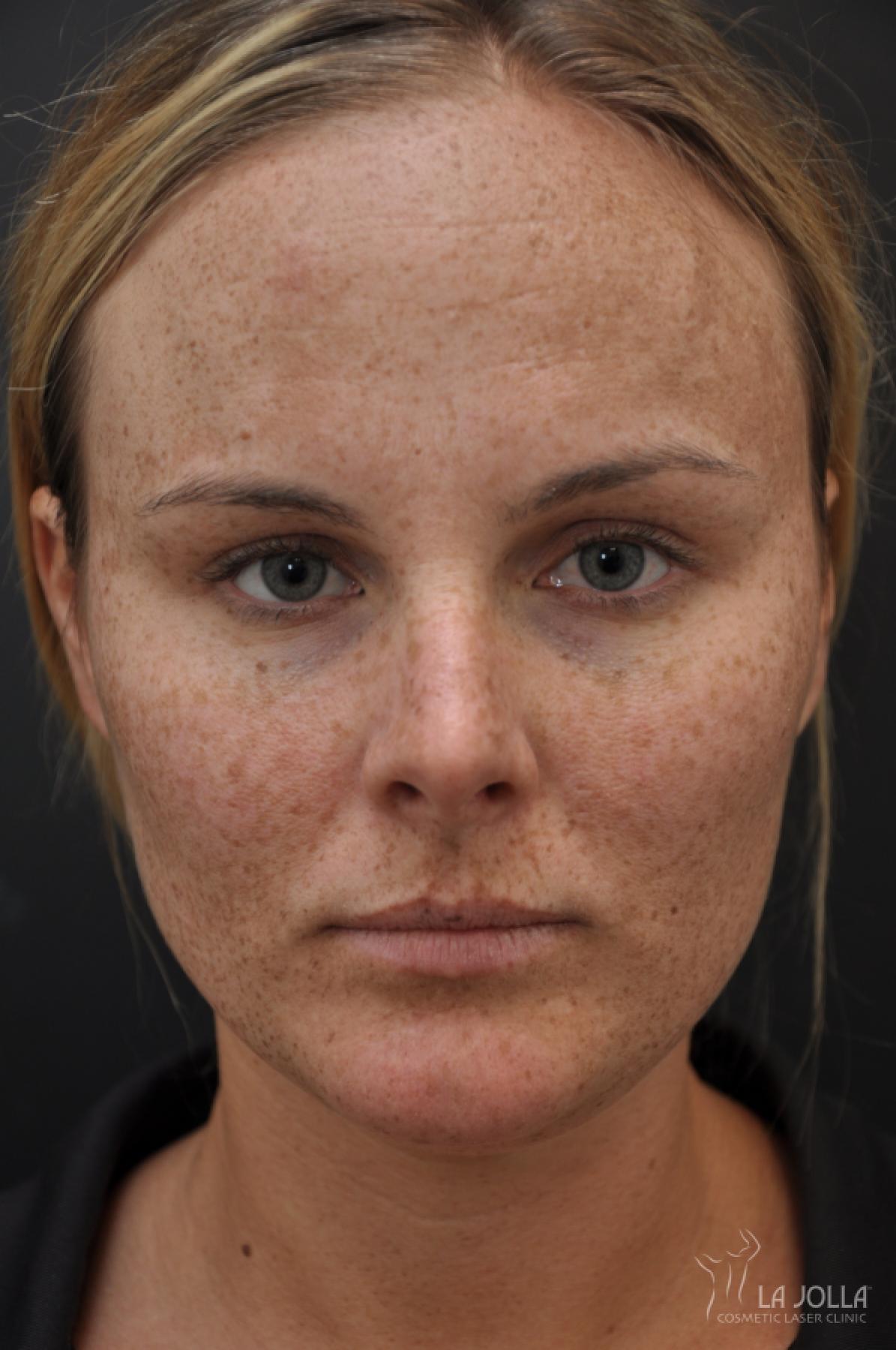 Chemical Peel: Patient 10 - Before 