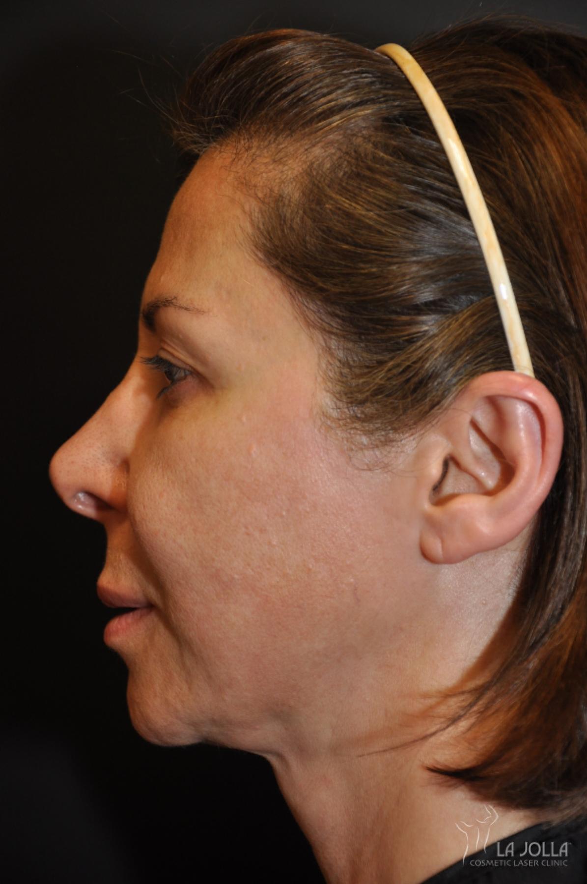 Ultherapy Patient 2 Before Procedure