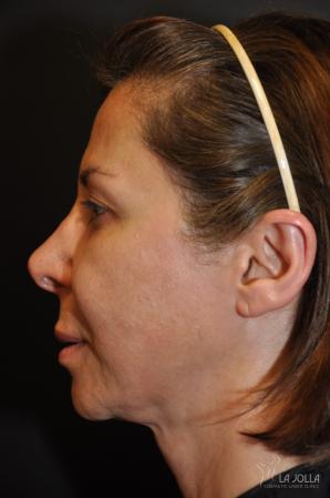 Ultherapy®: Patient 3 - Before 