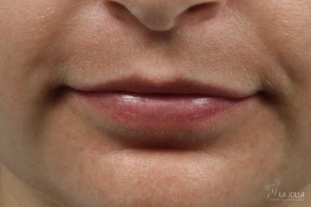 Lip Filler: Patient 1 - Before 