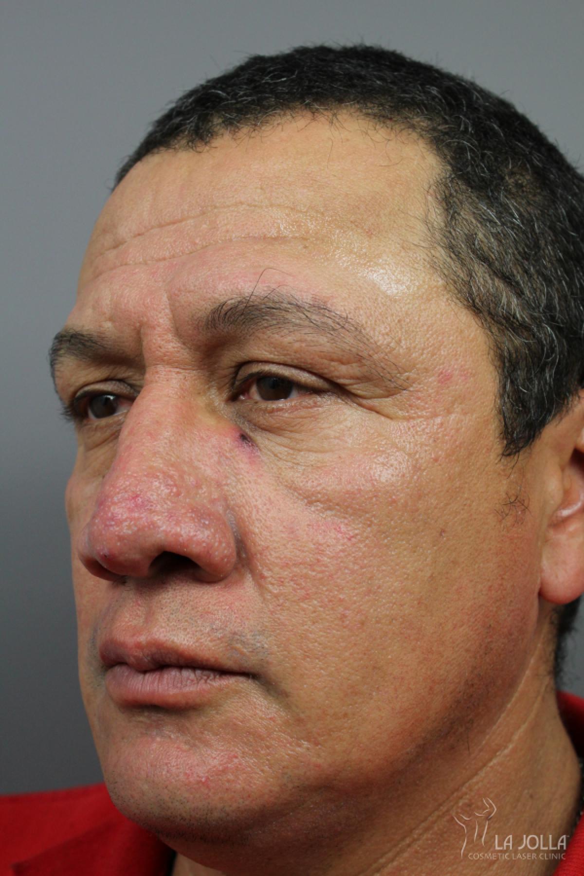 IPL PhotoFacial Patient 1 After Procedure