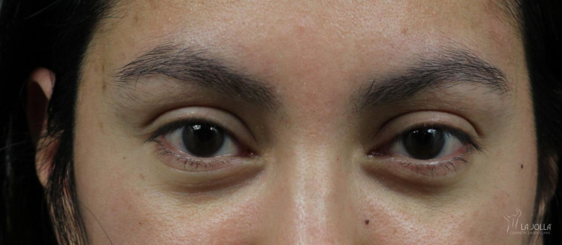 Under Eye Filler: Patient 6 - Before 1
