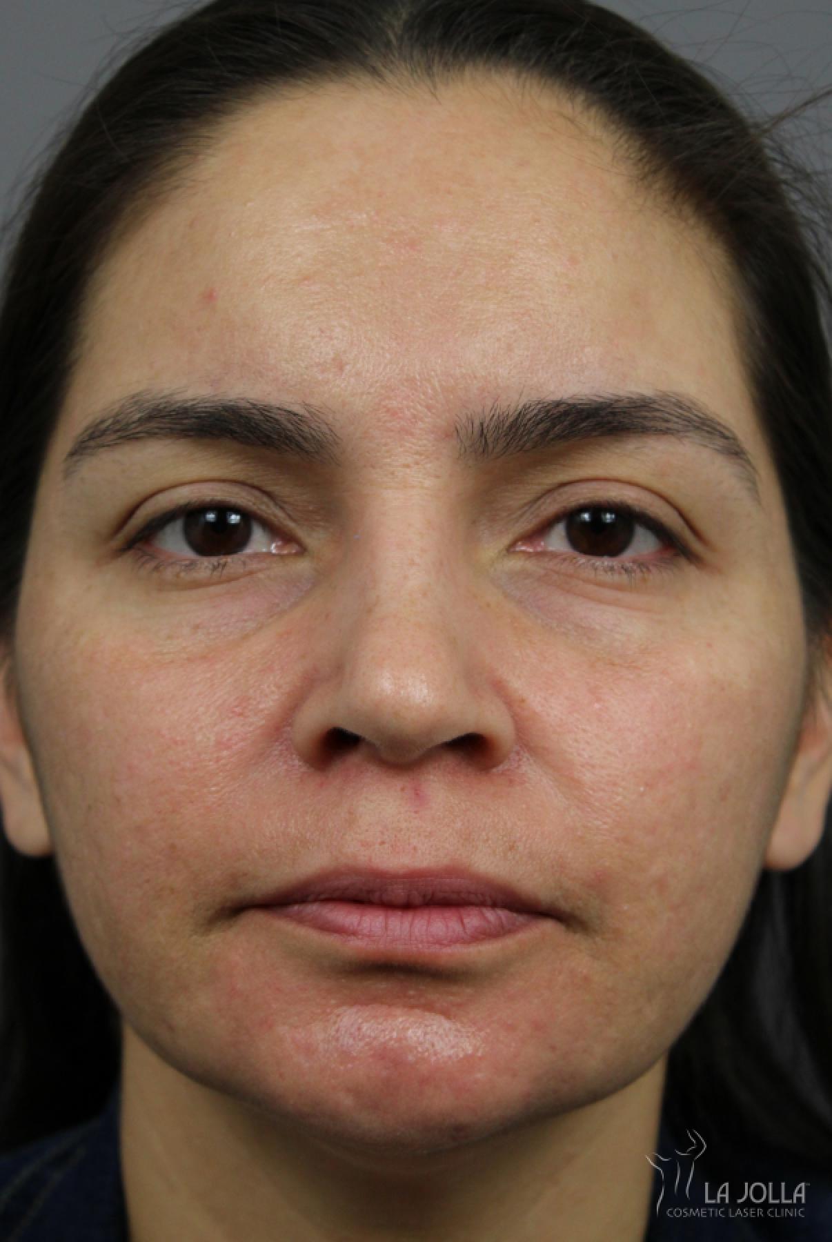 Acne Scars: Patient 3 - After 2
