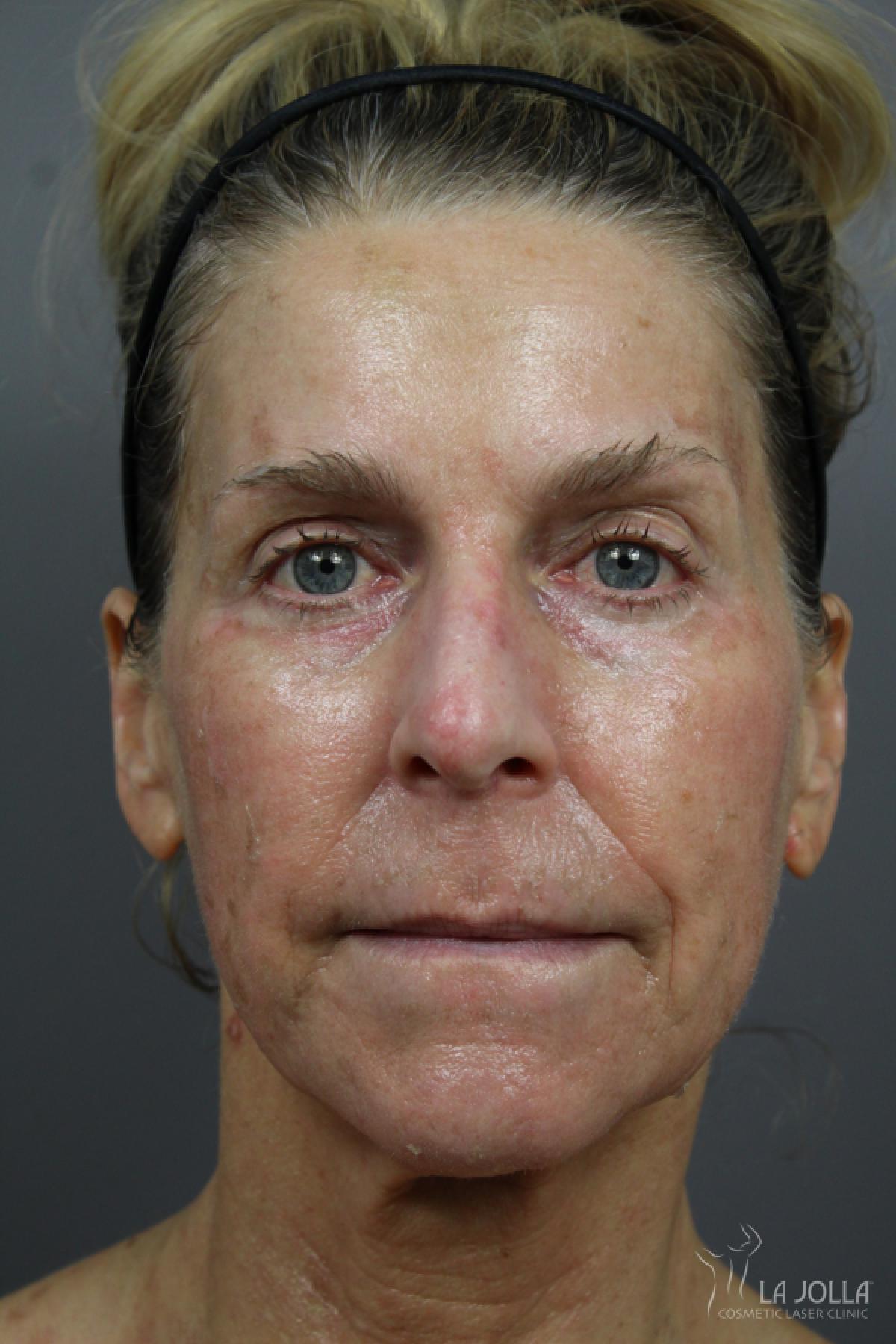 6D Platinum Laser Lift: Patient 3 - After 1