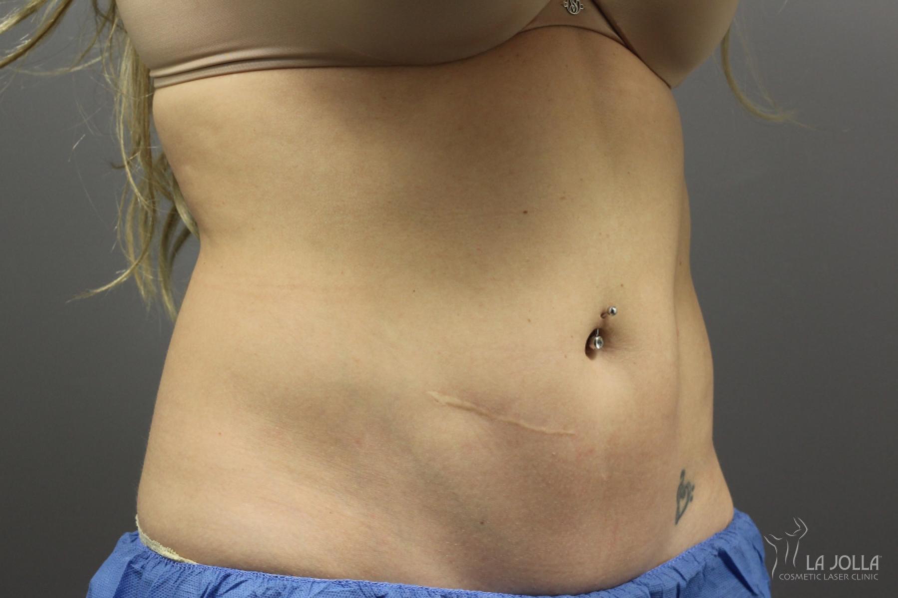 CoolSculpting®: Patient 2 - After 1