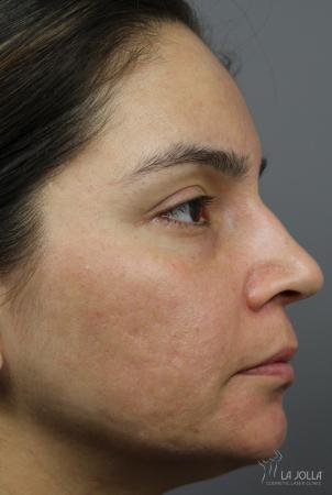 Acne Scars: Patient 3 - After  