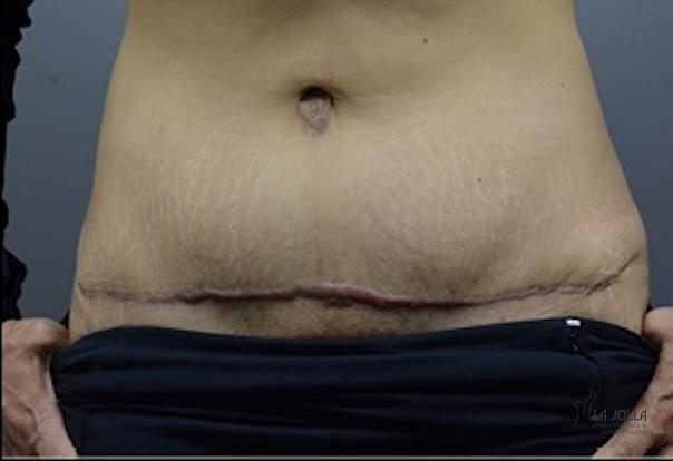 ResurFX: Patient 7 - Before 1