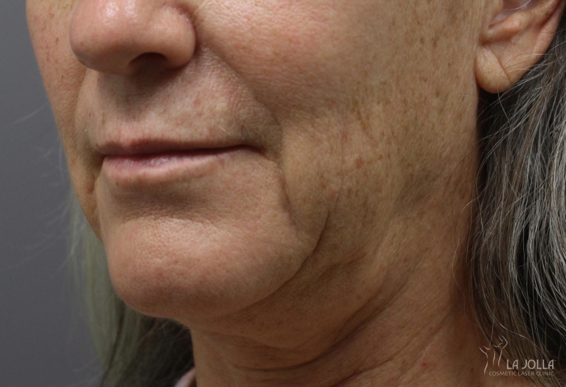 Ultherapy®: Patient 5 - Before 