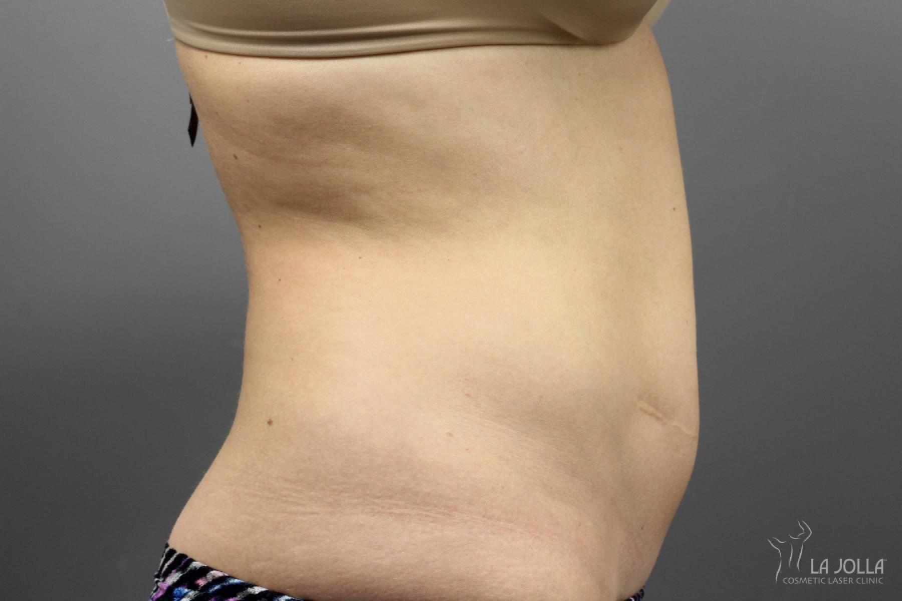 CoolSculpting®: Patient 2 - Before and After 3