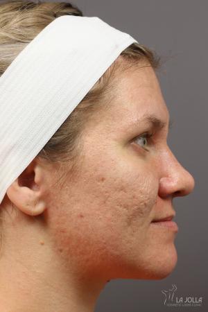 Juvéderm® XC: Patient 5 - Before 