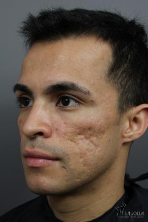 Acne Scars: Patient 4 - Before 