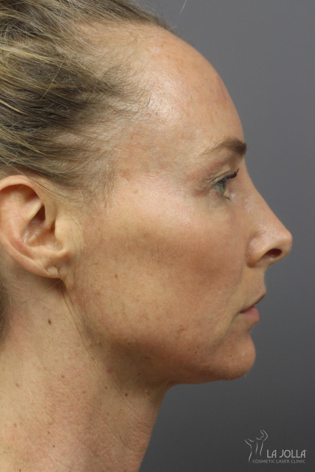 CO2 Laser: Patient 21 - After 2