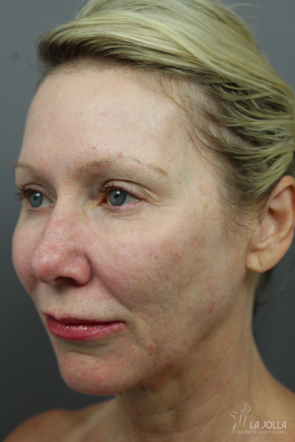 6D Platinum Laser Lift: Patient 4 - After 2