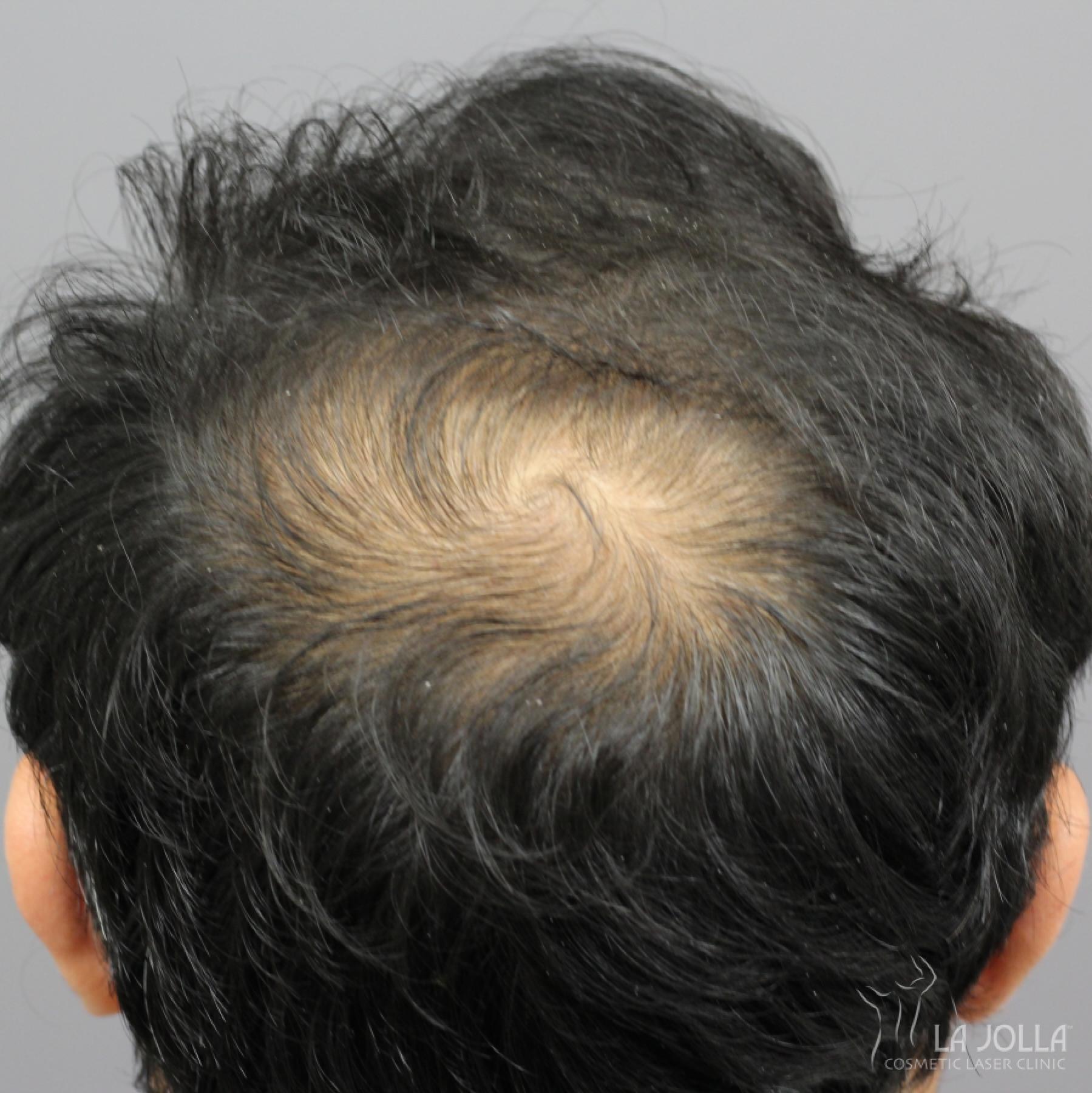 Hair Restoration: Patient 5 - Before 