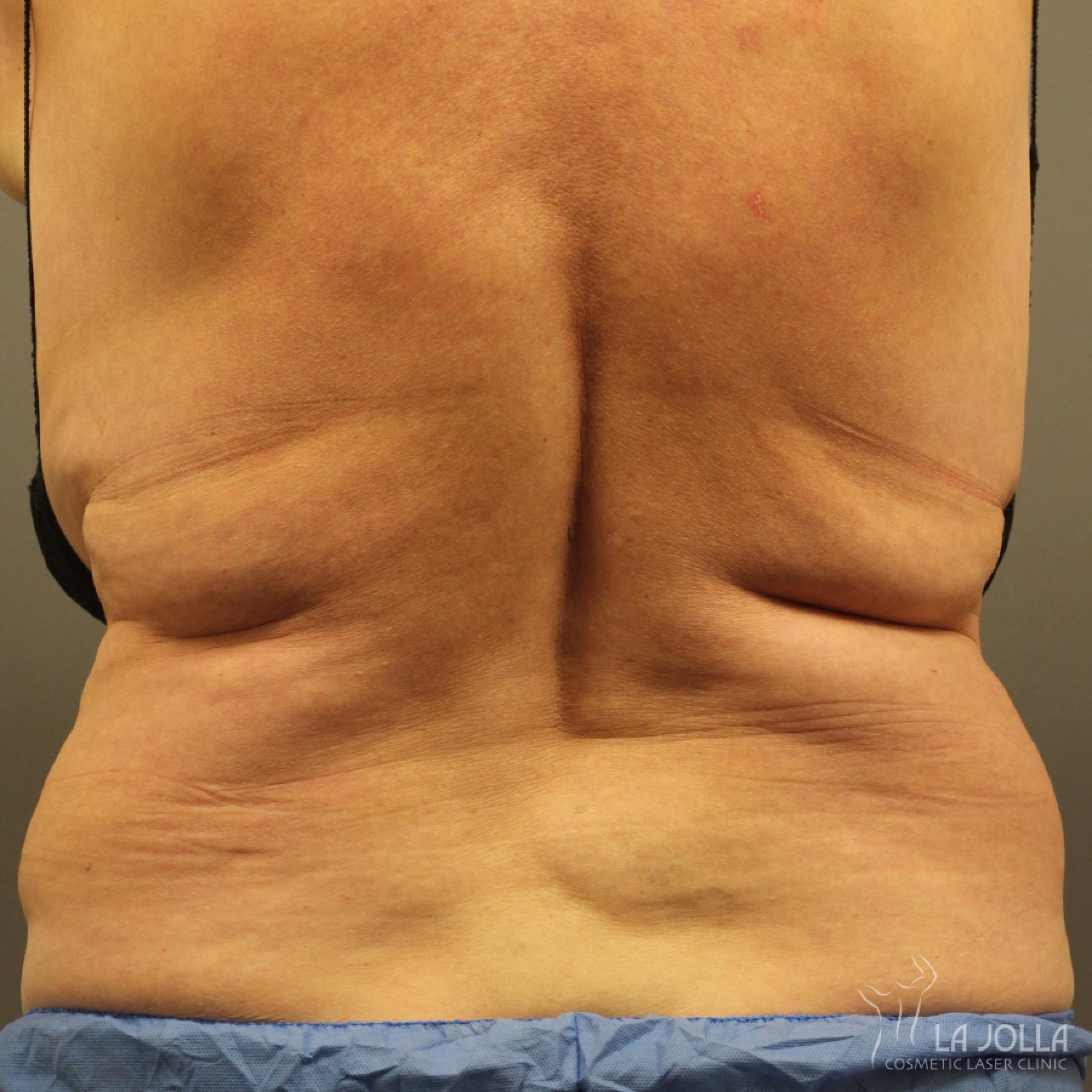 CoolSculpting®: Patient 9 - Before 