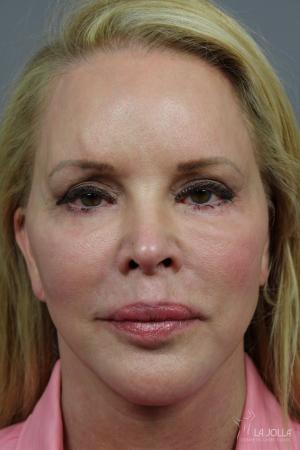 Liquid Facelift: Patient 4 - Before 