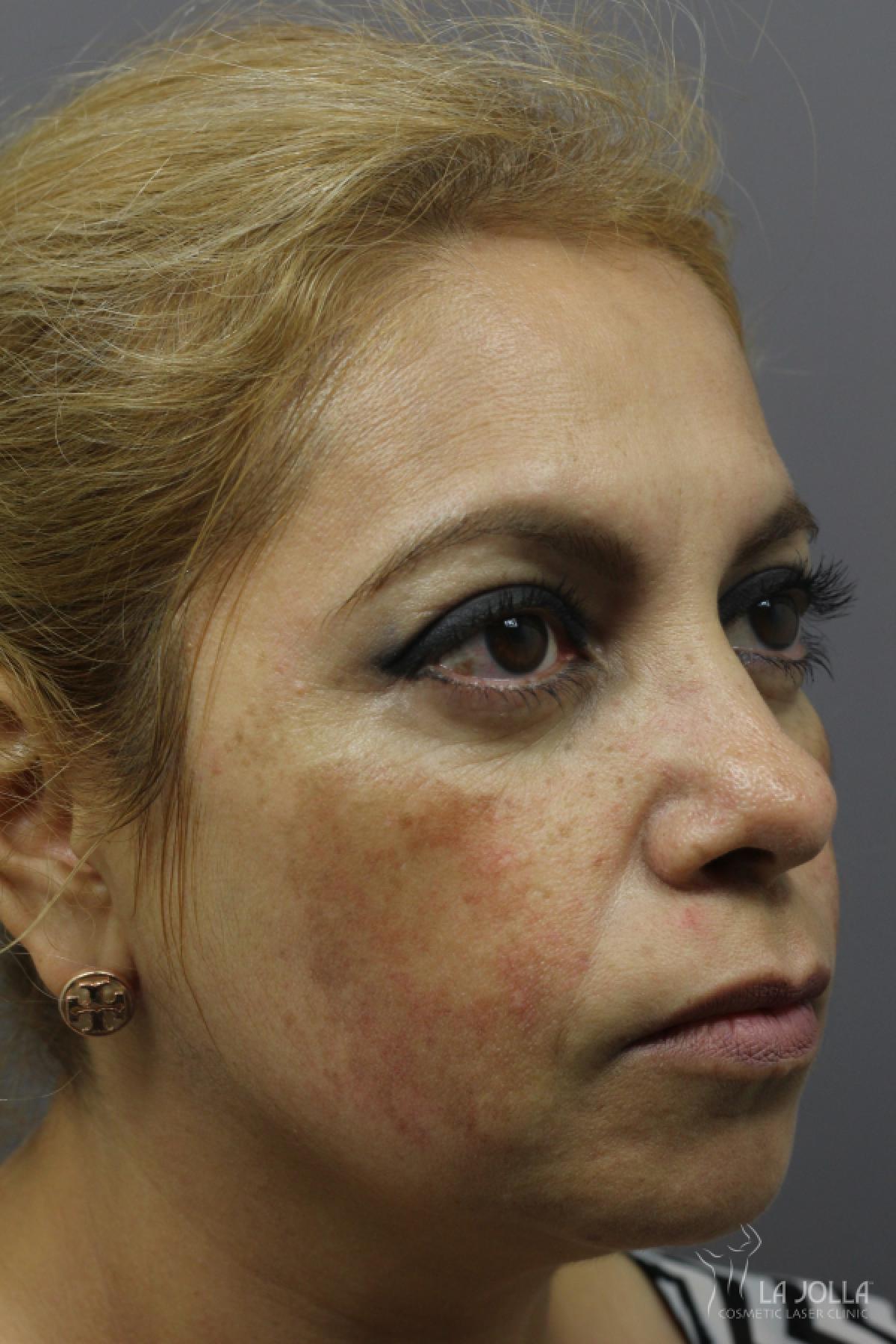 Chemical Peel: Patient 7 - Before and After 2