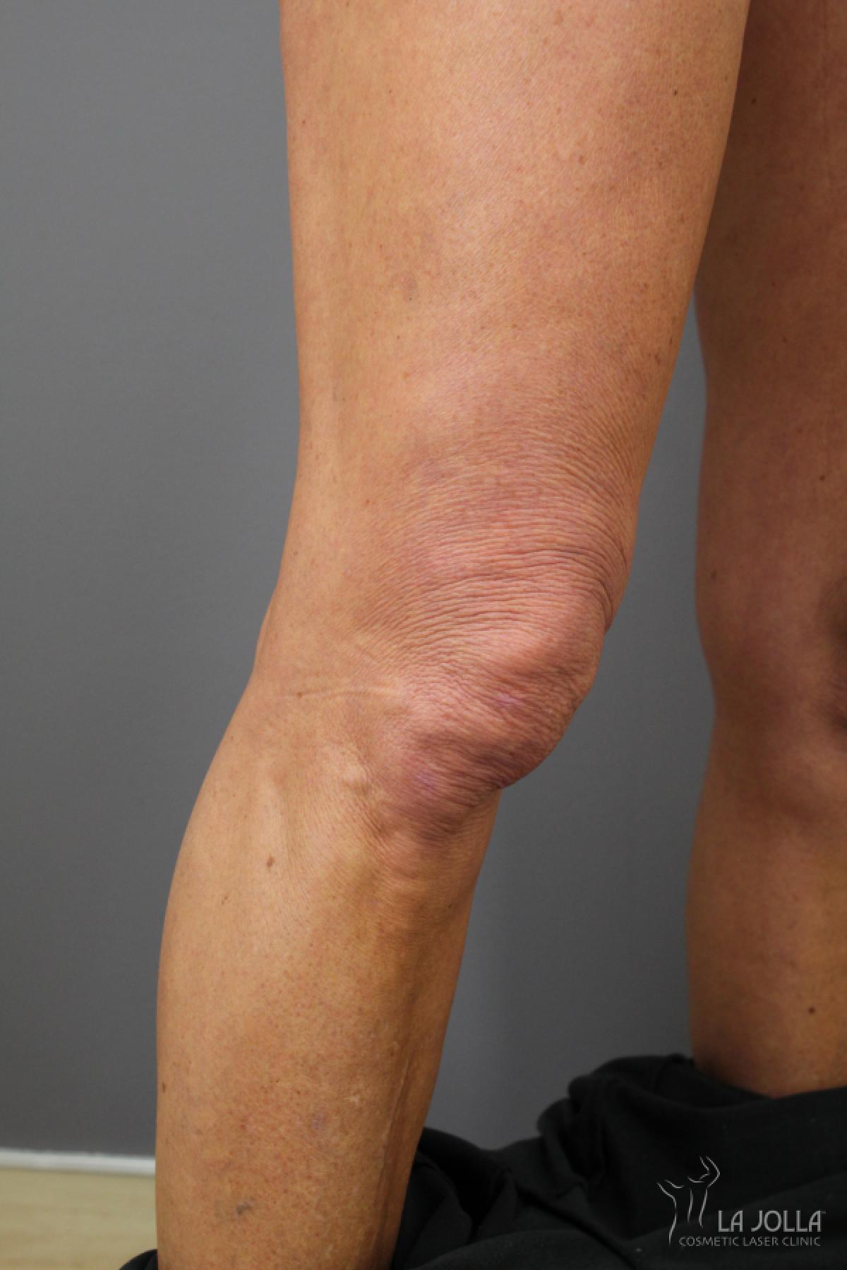 StarWalker® Laser: Patient 5 - After 1