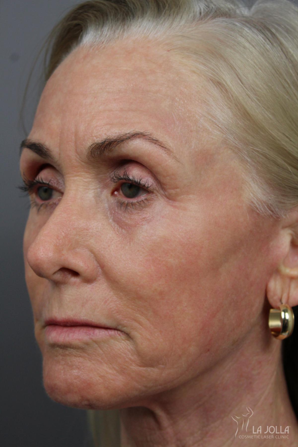 CO2 Laser: Patient 11 - After 3