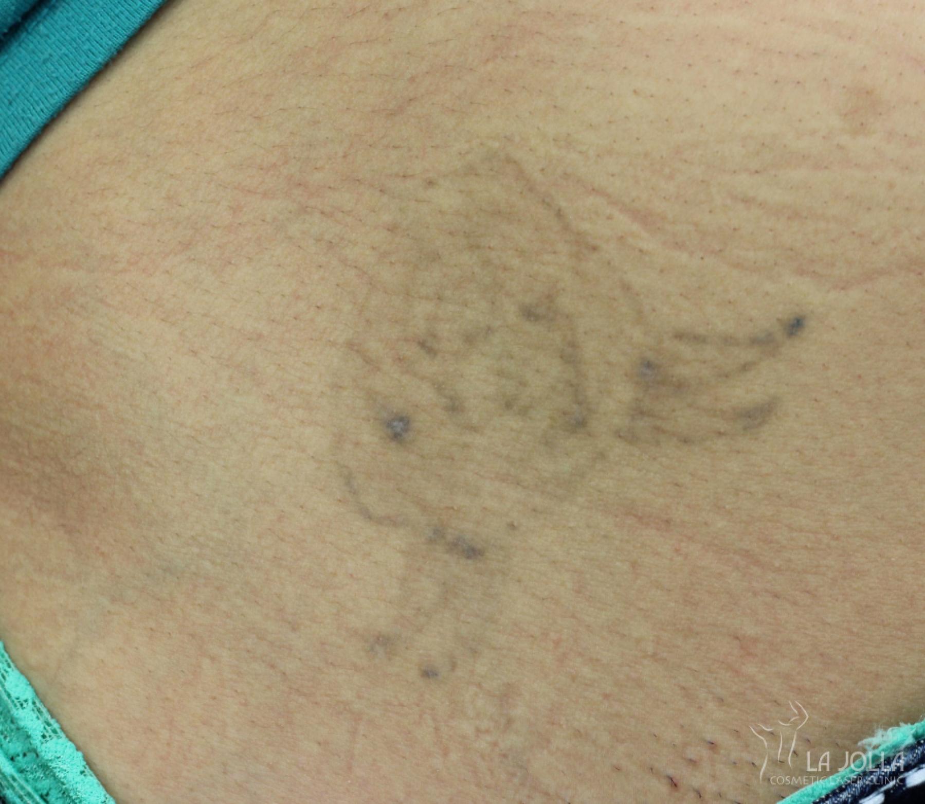 Tattoo Removal: Patient 4 - After 1