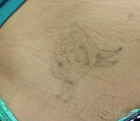 Tattoo Removal: Patient 4 - After  
