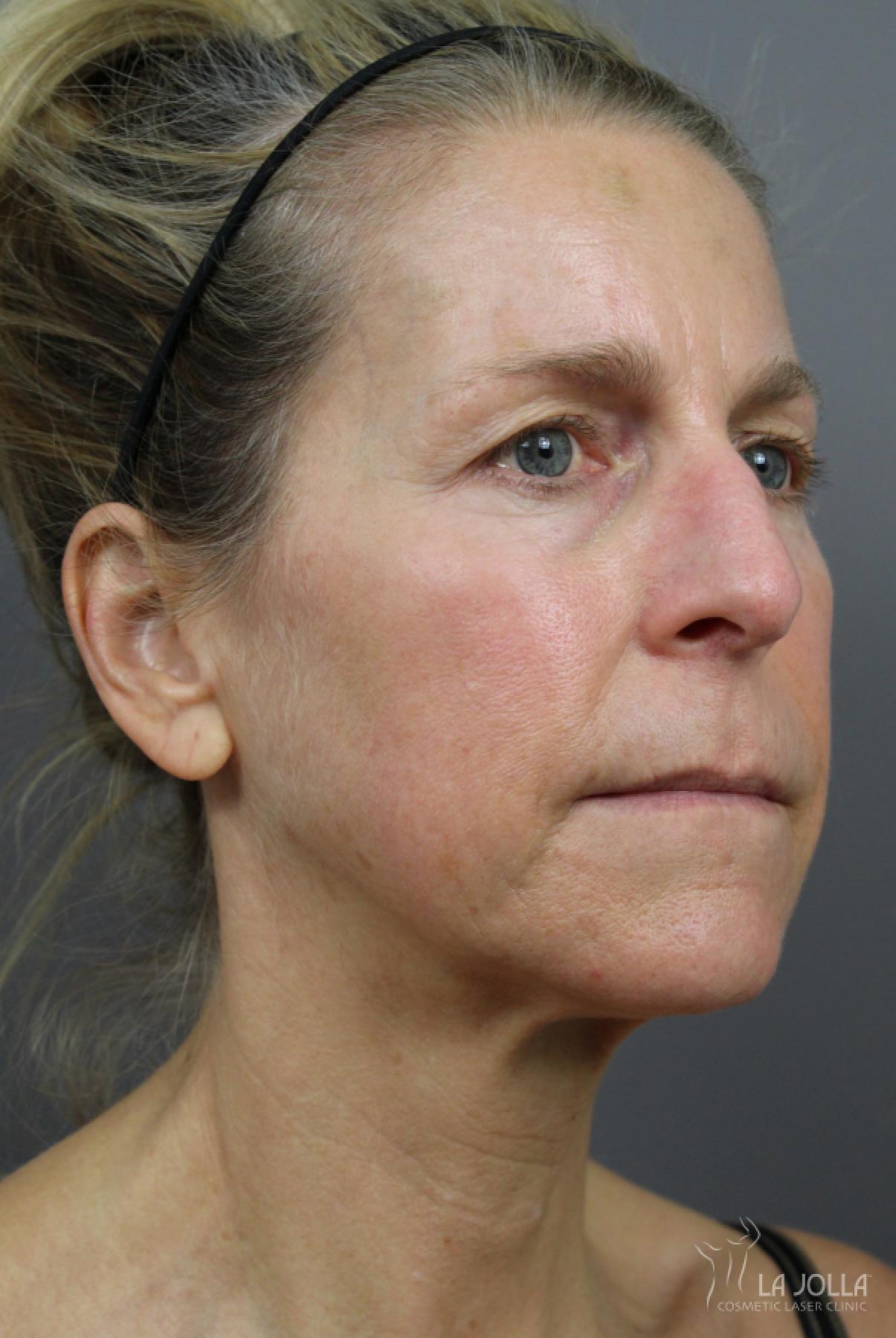 6D Platinum Laser Lift: Patient 3 - Before 2