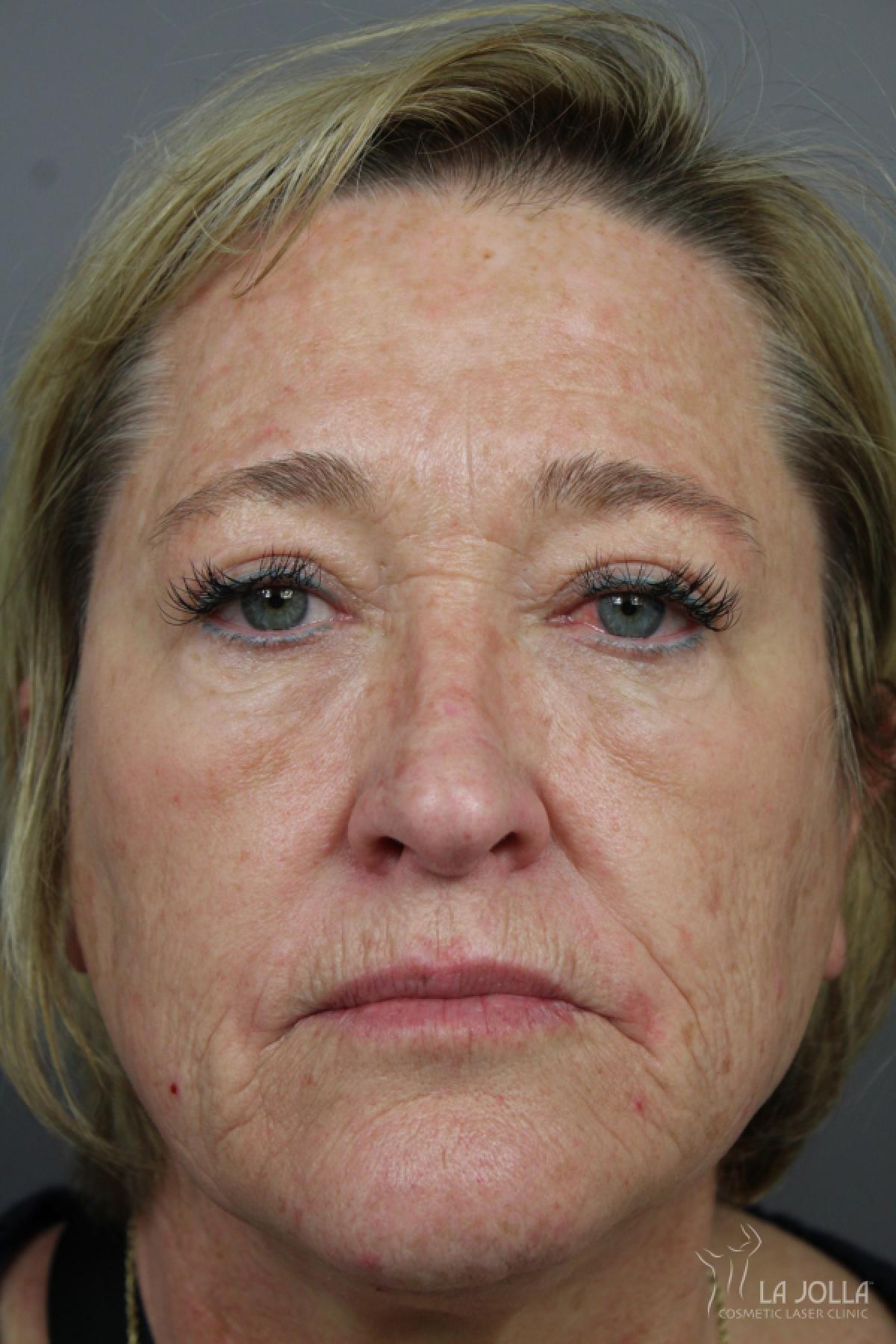 CO2 Laser: Patient 22 - Before 1