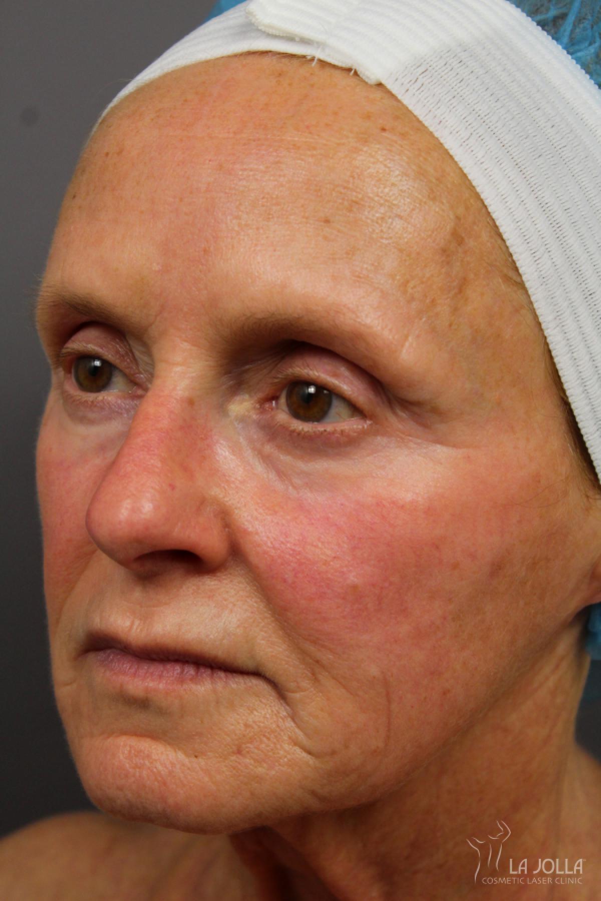 CO2 Laser: Patient 18 - Before 1