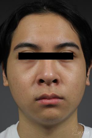 Fraxel®: Patient 3 - After  