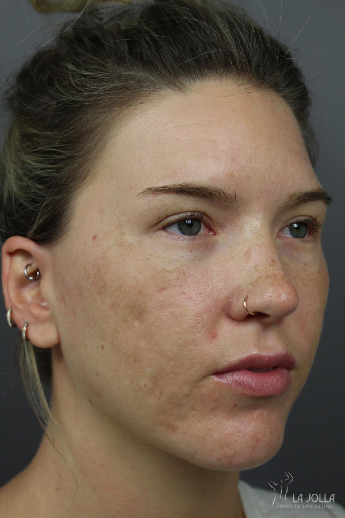 Acne Scarring Patient 1 After Procedure