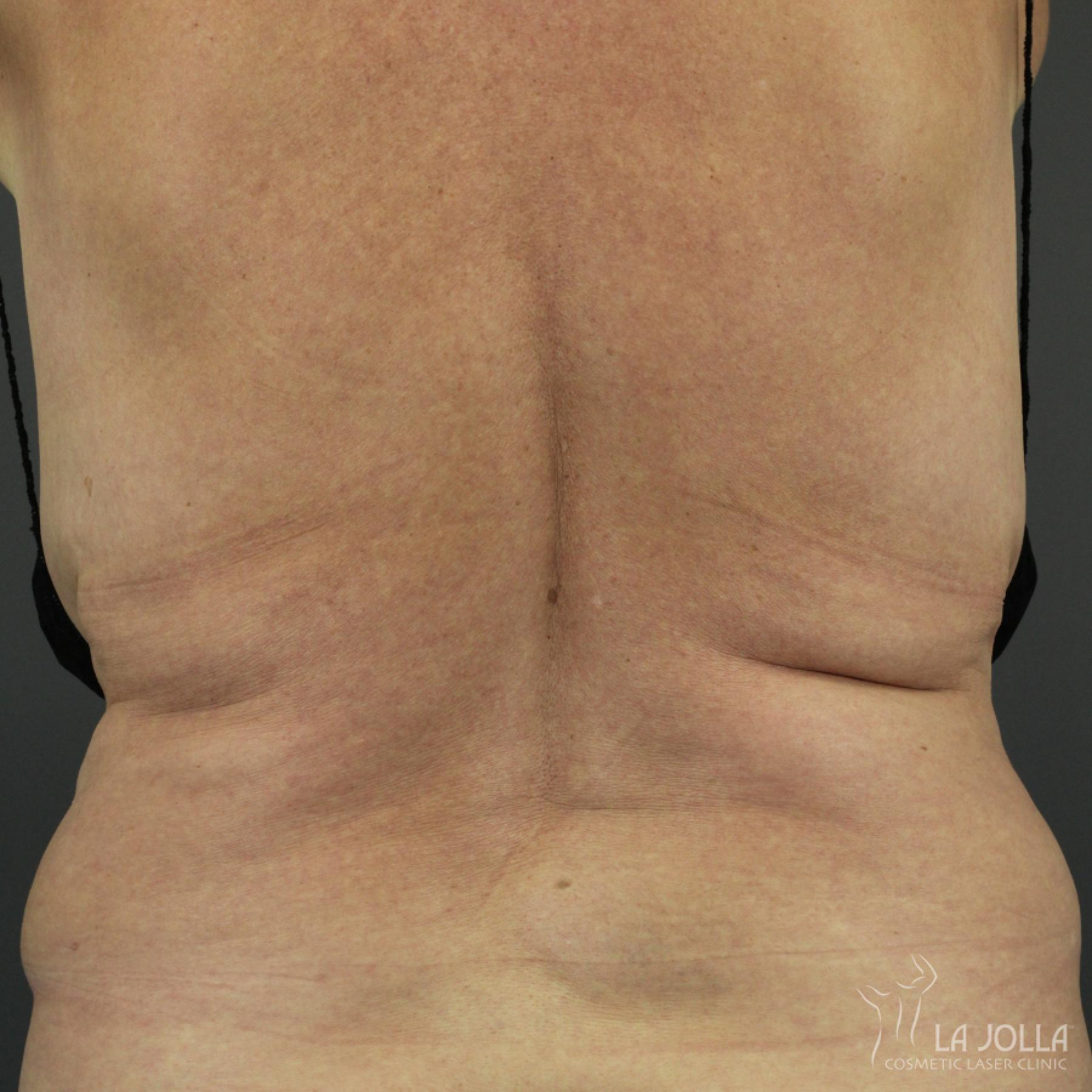 CoolSculpting Patient 1 After Procedure