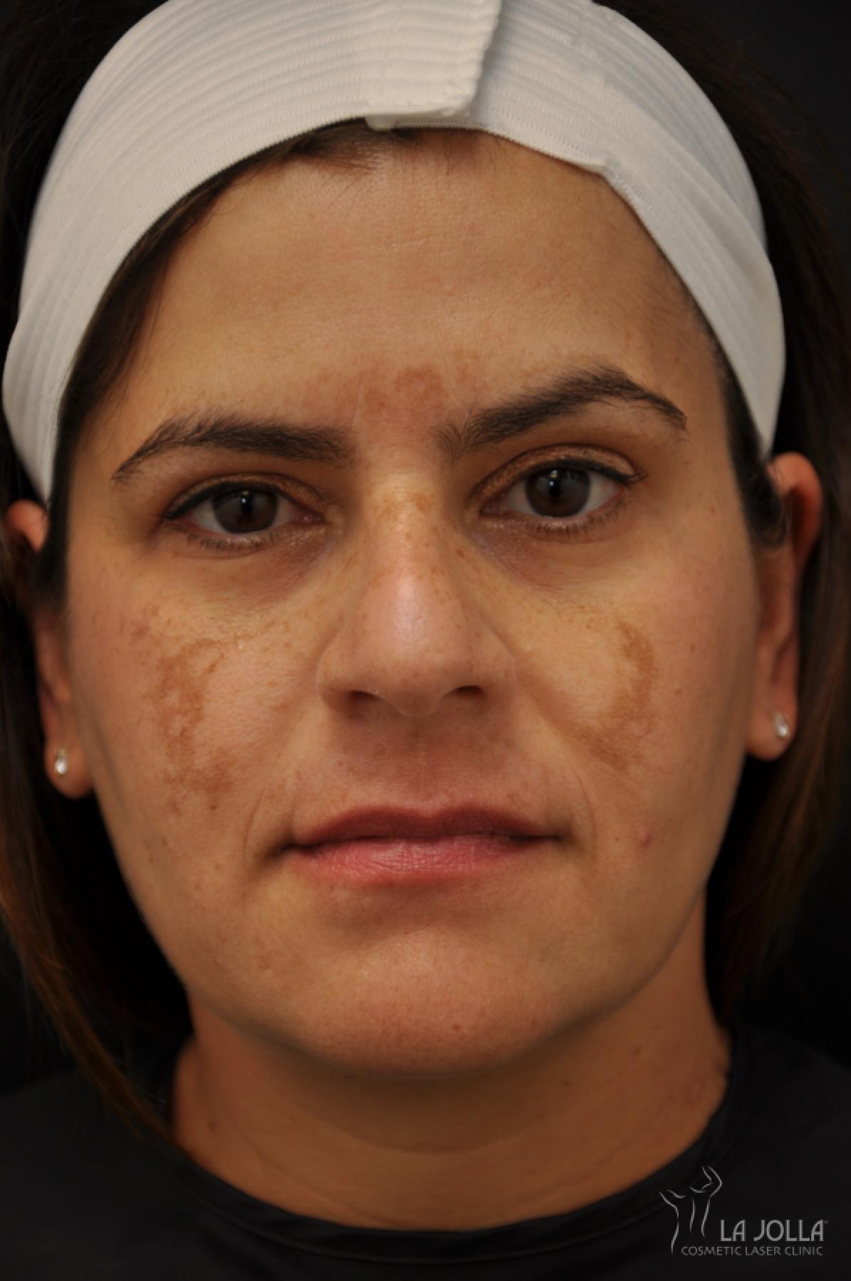 Chemical Peel: Patient 9 - Before 