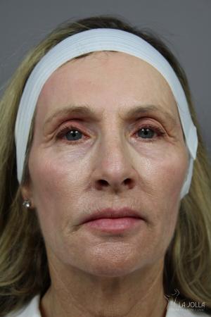 Liquid Facelift: Patient 3 - After  