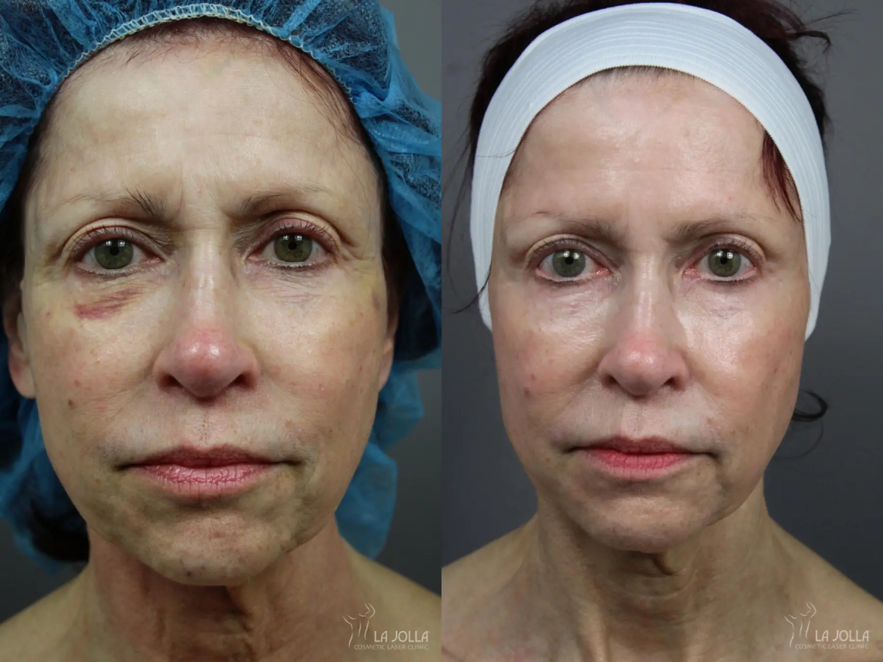 6D Platinum Laser Lift: Patient 5 - Before and After 1