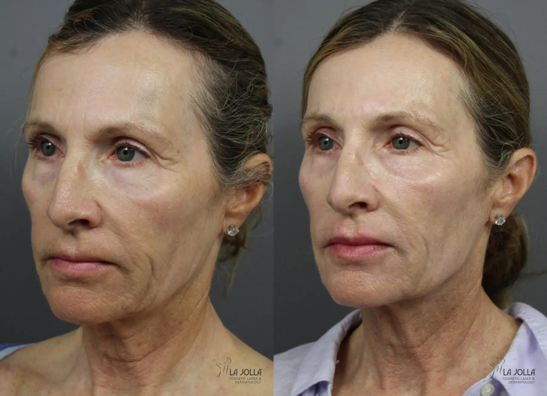 6D Platinum Laser Lift: Patient 2 - Before and After  