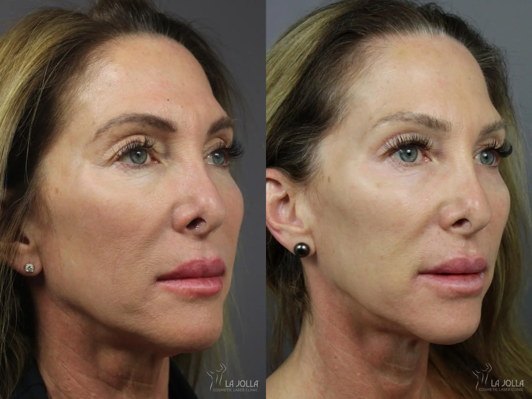 6D Platinum Laser Lift of Eyes and Cheeks Before and After - Before and After 1