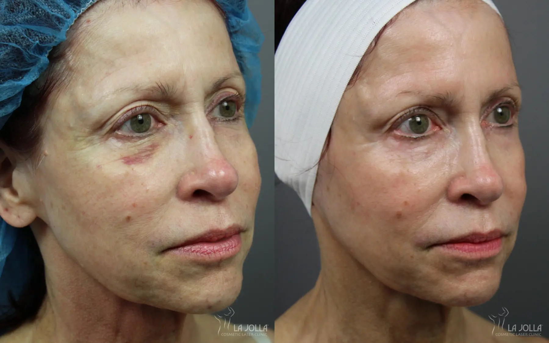 6D Platinum Laser Lift: Patient 5 - Before and After 2