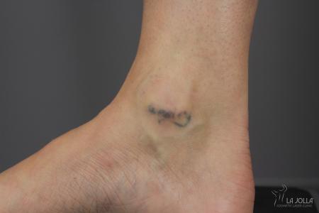 Tattoo Removal: Patient 2 - After  