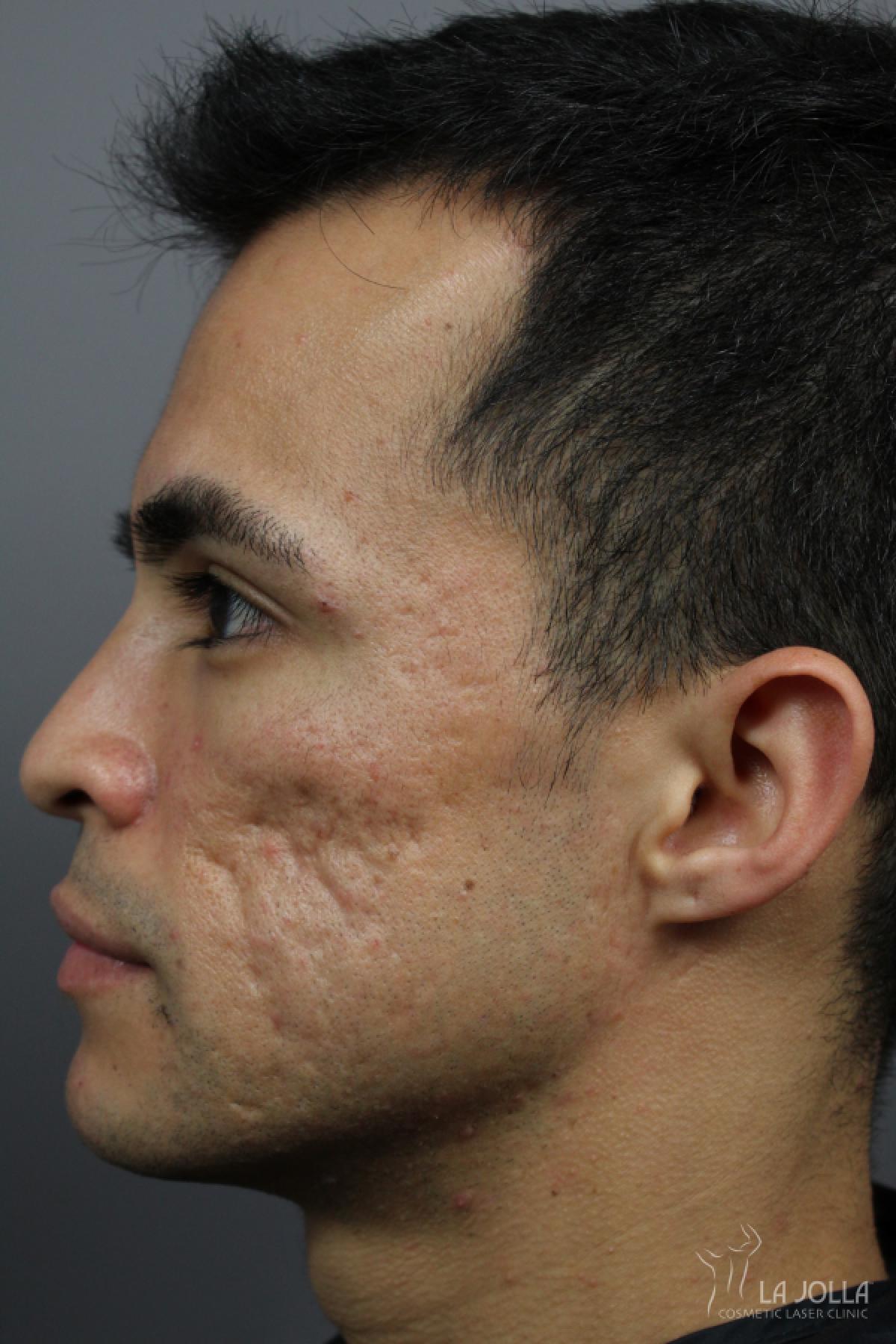 Acne Scars: Patient 4 - Before and After 4