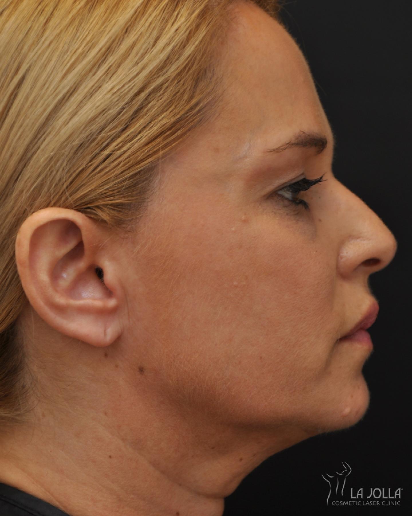 Ultherapy®: Patient 2 - After  