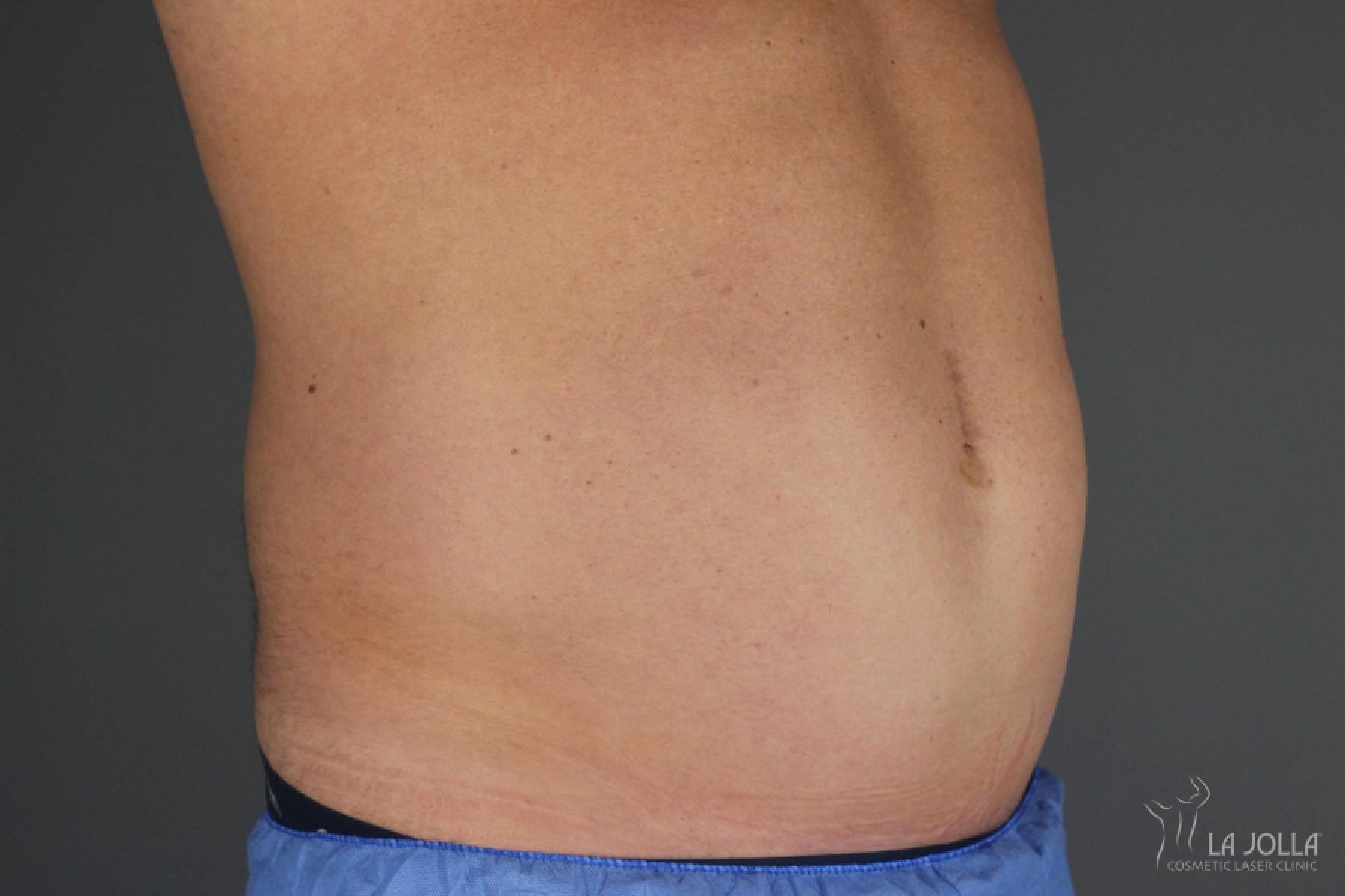 CoolSculpting®: Patient 14 - After 1