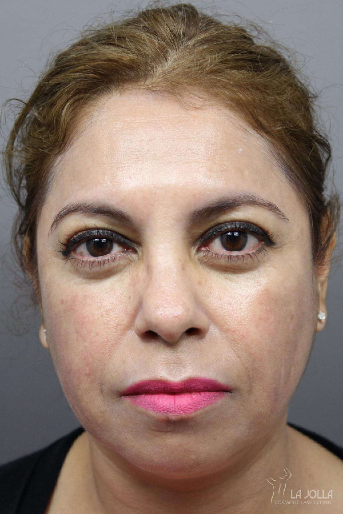 Chemical Peel: Patient 7 - After 1