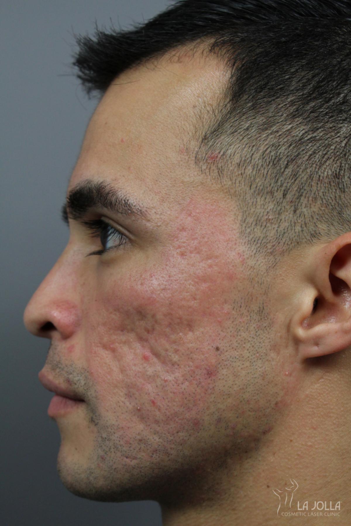 Acne Scars: Patient 4 - After 4
