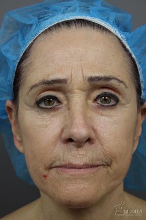 Sculptra®: Patient 7 - Before 