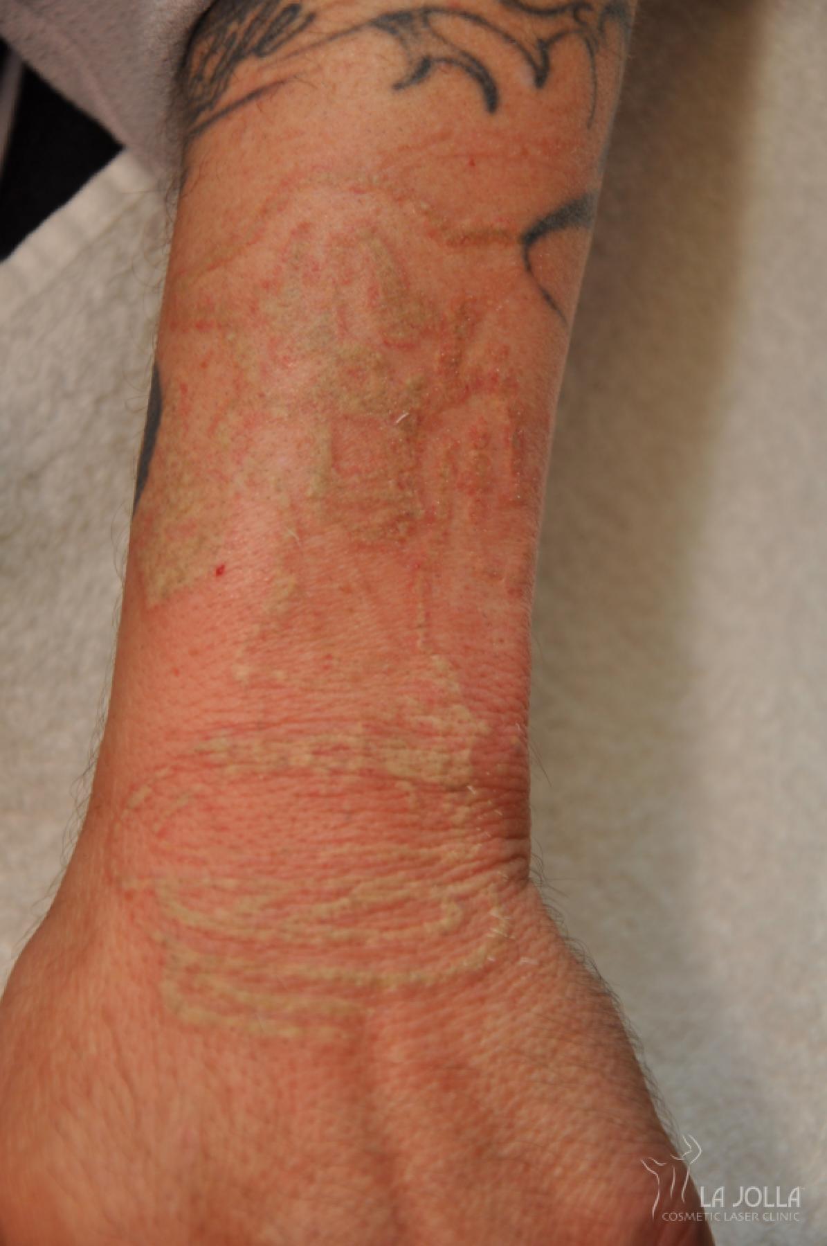 Laser Tattoo Removal Patient 1 After Procedure