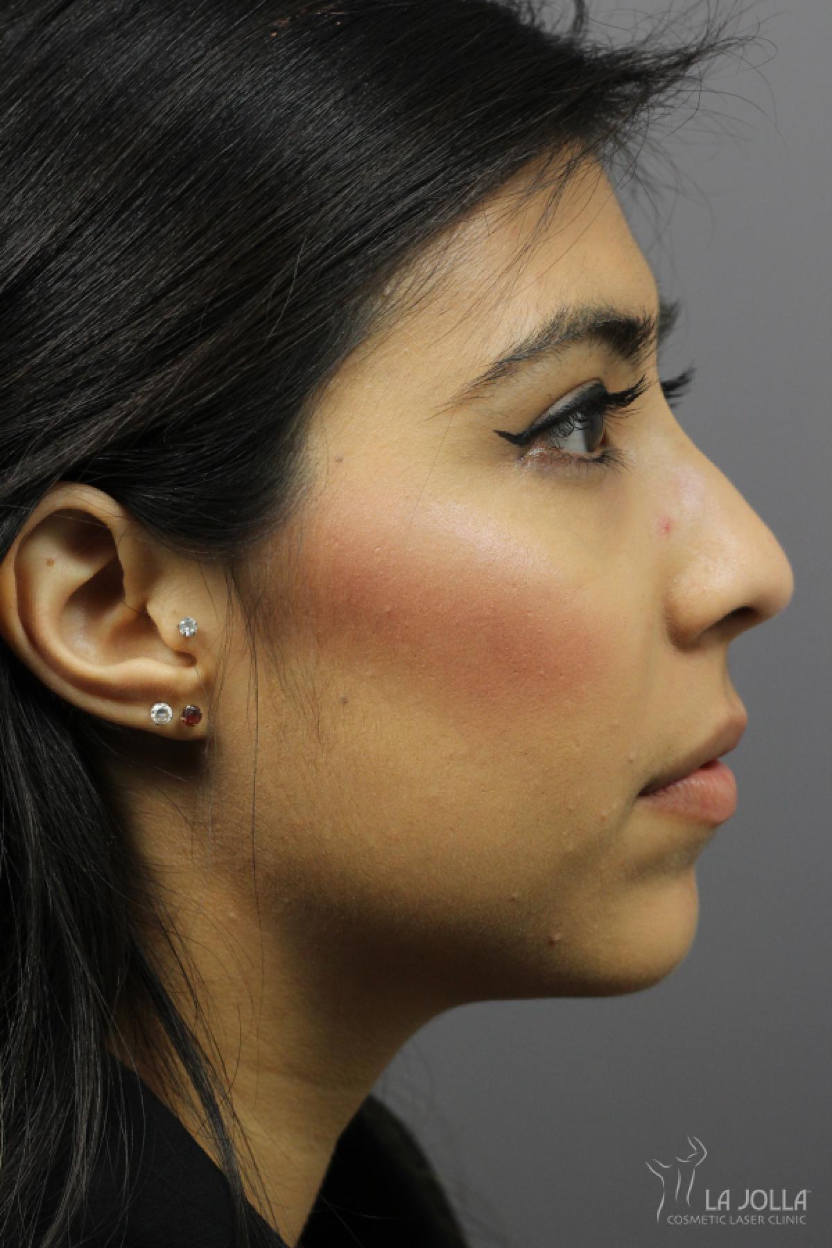 Nose Filler: Patient 7 - After 1