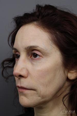 Liquid Facelift: Patient 2 - Before 