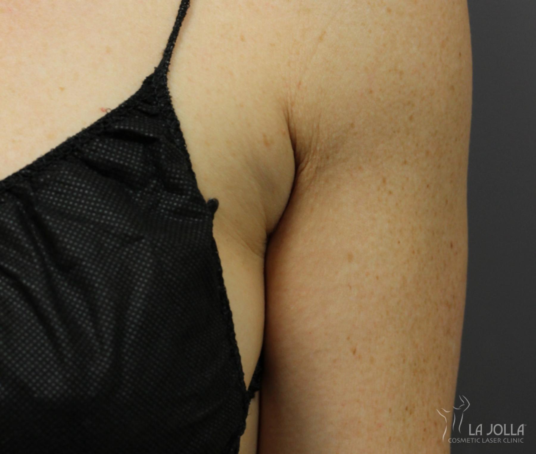 CoolSculpting®: Patient 12 - Before 1