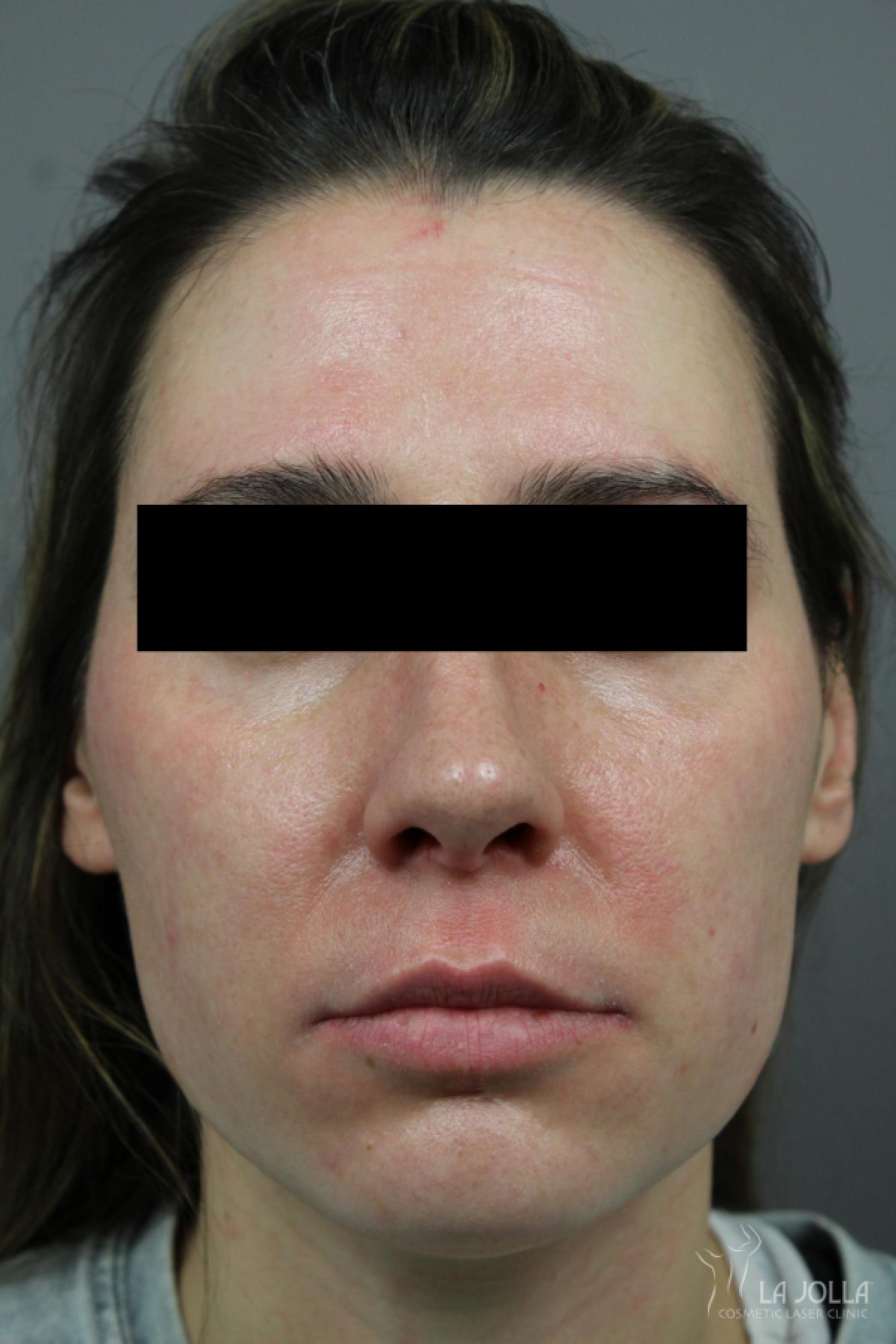 Chemical Peel: Patient 13 - After 1
